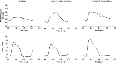 Acute and Long-Term Effects of Aortic Compliance Decrease on Central Hemodynamics: A Modeling Analysis